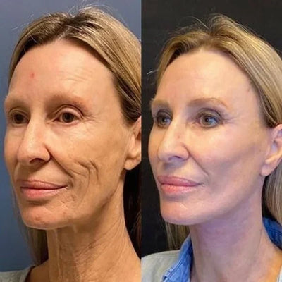 SkinLife™ | Botox Gesicht Serum