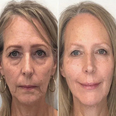 SkinLife™ | Botox Gesicht Serum